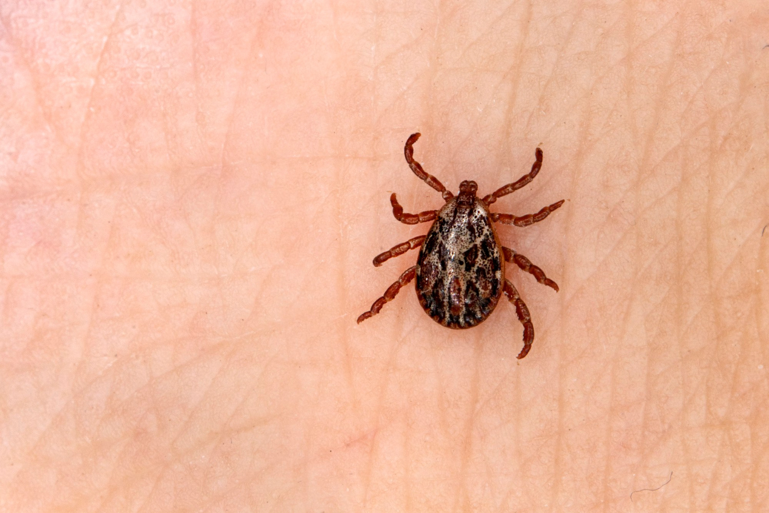 lyme disease